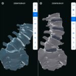 3D Printing Corrects Patient’s Spine and Adds Height