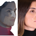 3D Printed Splints vs. Nasal Taping Post-Rhinoplasty