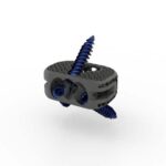 Orthofix Medical Launches Wave-like Printed Implant