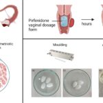 3D Printed Vaginial Ovules Show Promise as Endometriosis and Leiomyoma Treatment