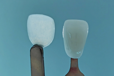 World’s Thinnest 3D Printed Cosmetic Dental Veneer Unveiled