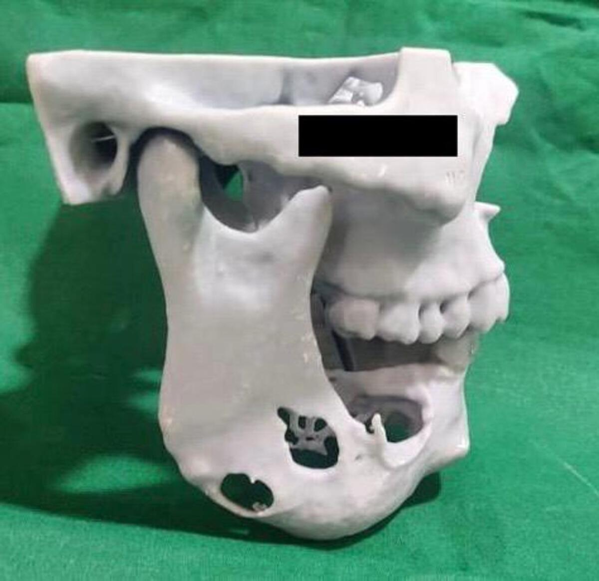 Filipino Expat Gets 3D Printed Jaw in Dubai