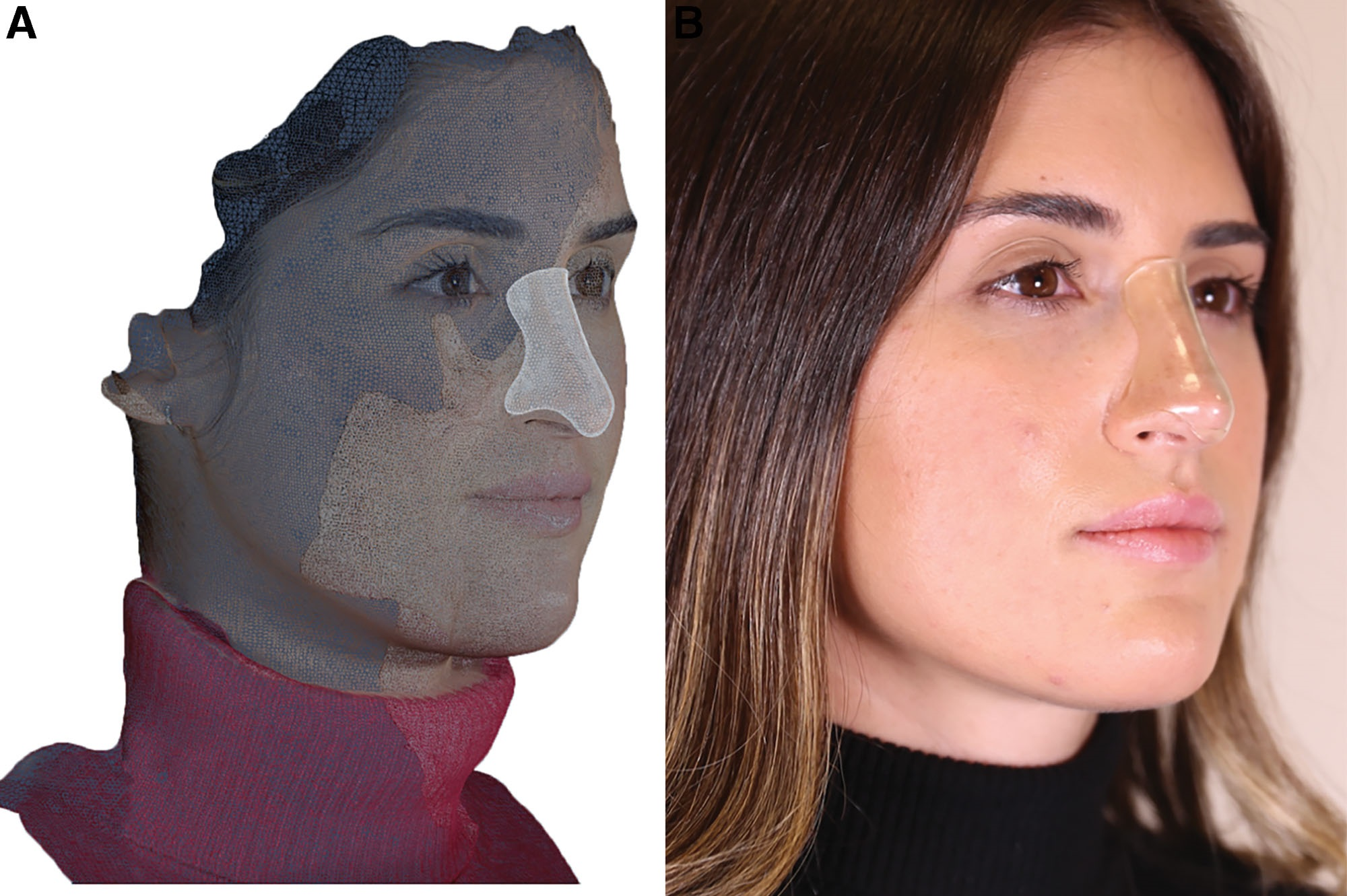 3D Printed Splints vs. Nasal Taping Post-Rhinoplasty
